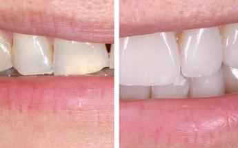 Comparison of Teeth Before and After